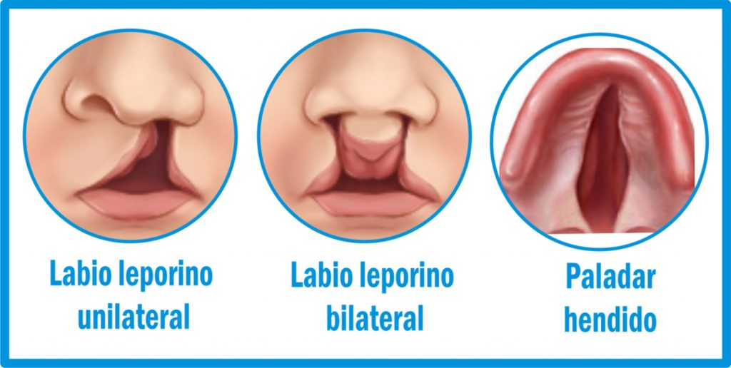  Labio leporino y fisura palatina