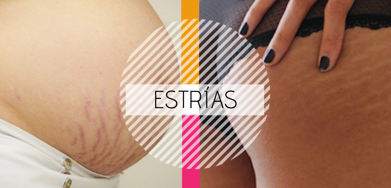 Cómo desaparecer las estrías? Trucos de una mamá