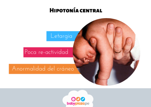 Bebé hipotónico: Causas y tratamiento - Mega Baby